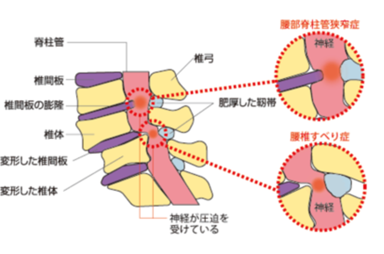 狭窄症